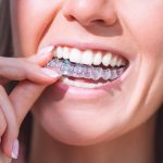 Crafting Your Desired Smile: The Art of Invisalign Innovation