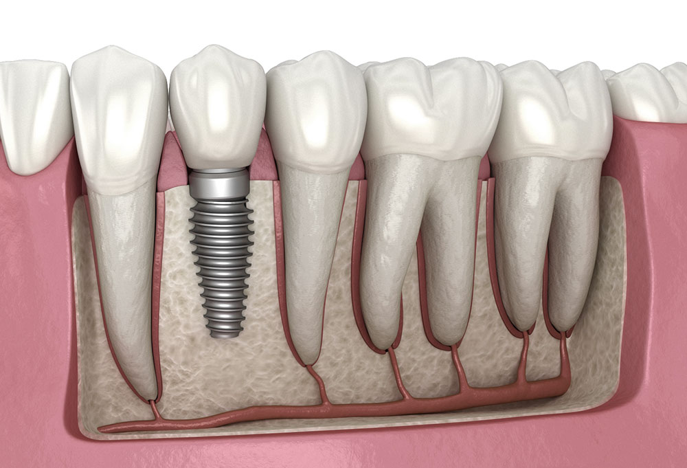 Aesthetic Precision: How Dental Implants Restore Natural Smiles